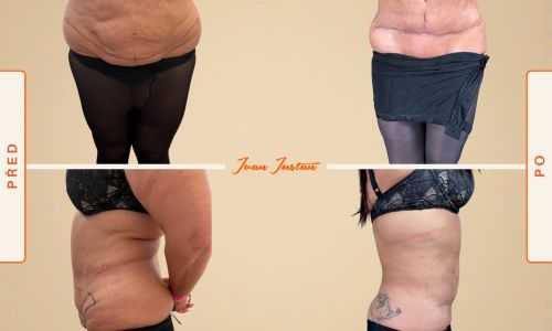 abdominoplastika
